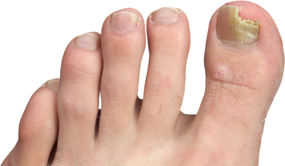 What is happening to my toenails?: Peachstate Advanced Cardiac &  Endovascular: Board Certified Interventional Cardiologists