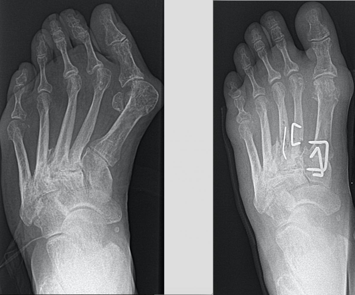 Metatarsal Osteotomy - Foot Treatment - Visa Medicure