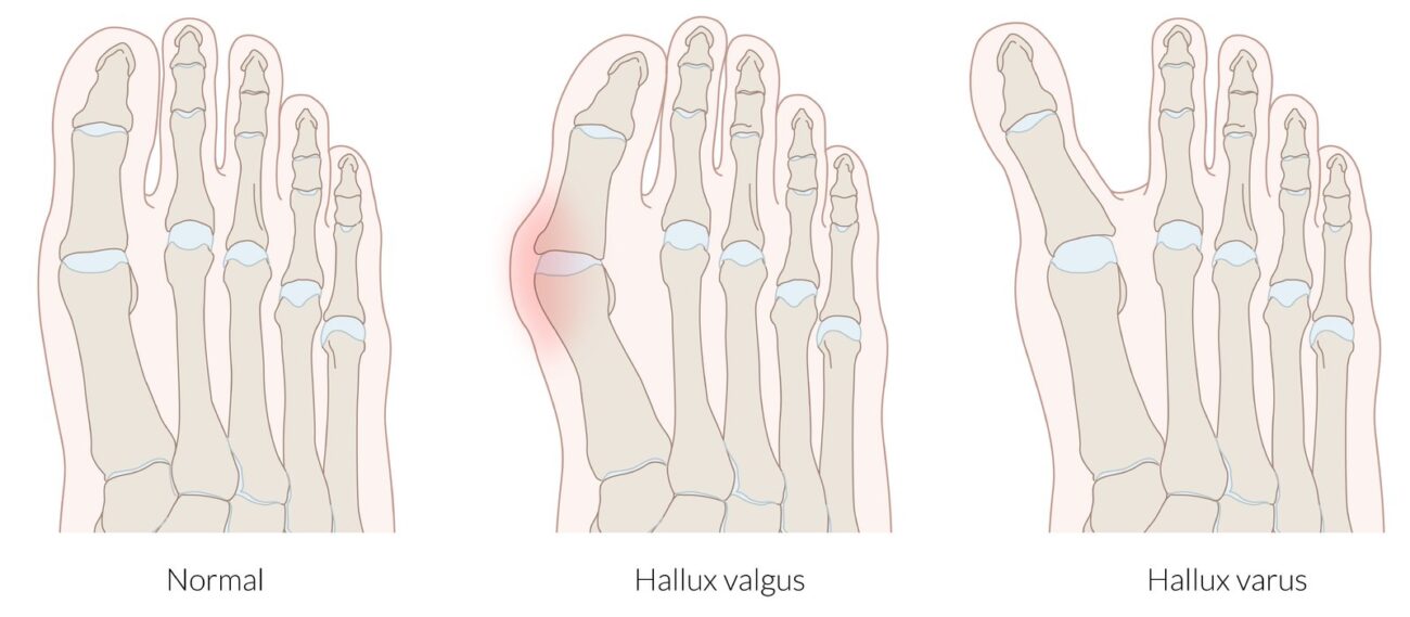 Hallux Varus Hallux Valgus Ankle & Foot ClinicDiabetes Foot clinic