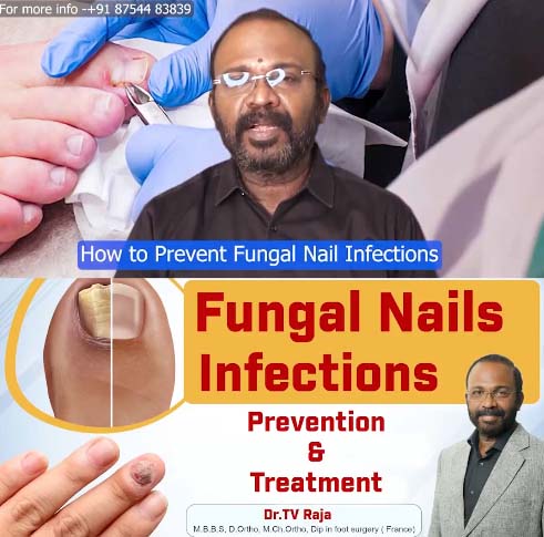 Fungal Nails Infections | Causes | Treatment | Symptoms - Dr.TV Raja